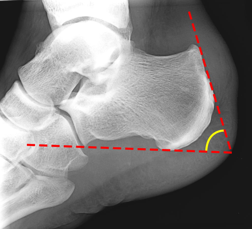 Morbo di Haglund Radiologia Ortopedica